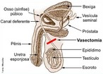 	  um procedimento em que os vasos deferentes (tubos que conectam os testculos ao pnis) so cortados. Assim a passagem dos espermatozides produzidos pelos testculos  bloqueada. </br></br> Palavras-chave: vasectomia, deferentectomia, mtodo contraceptivo, esterilizao. 