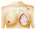 O cncer de mama ocorre quando as clulas deste rgo passam a se dividir e a se reproduzir muito rpido e de forma desordenada. A maioria dos cnceres de mama acomete as clulas dos ductos das mamas. Ele pode ser in situ, quando no passa das primeiras camadas de clula destes ductos, ou invasor, quando invade os tecidos em volta. Os cnceres que comeam nos lbulos da mama so chamados de Carcinoma Lobular e so menos comuns que o primeiro. Este tipo de cncer muito frequentemente acomete as duas mamas. O Carcinoma Inflamatrio de mama  um cncer mais raro e normalmente se apresenta de forma agressiva, comprometendo toda a mama, deixando-a vermelha, inchada e quente. <br /><br /> Palavras-chave: cncer de mama, preveno, clula, carcinoma lobular, carcinoma inflamatrio.