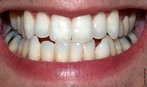 Os dentes cortam, prendem e trituram os alimentos. Num ser humano adulto, existem 32 dentes, dezesseis em cada arco dental. </br></br> Palavras-chave: dente, digesto, mastigao.