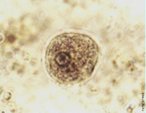 Esse protozorio, habitante do intestino grosso humano, pertence ao sub-filo Sarcodina, tendo forma amebide e locomovendo-se atravs de pseudpodos. Caracteriza-se por apresentar uma fase de vida comensal, por isso 90% dos casos de amebase so assintomticos, entretanto o parasito pode ser tornar patognico, provocando quadros disentricos de gravidade varivel. A amebase assintomtica costuma ocorrer mais no centro-sul do pas, enquanto a sintomtica ocorre com mais freqncia na regio amaznica. </br></br> Palavras-chave: protista, protozorio, ameba, <em>Entamoeba histolytica</em>, 