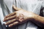 Leishmaniose cutnea  a forma mais comum de leishmaniose. Trata-se de uma infeco da pele causada por um parasita unicelular e transmitida por uma picada de Mosquito-palha. H cerca de vinte espcies de Leishmania que podem causar leishmaniose cutnea. </br></br> Palavras-chave: leishmaniose, parasita, protozorio.