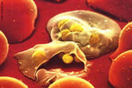 A imagem mostra as hemcias destrudas pelos protozorios causadores da malria. A malria  causada por protozorios do gnero Plasmodium, como o Plasmodium vivax, Plasmodium falciparum, Plasmodium malariae e Plasmodium ovale: os dois primeiros ocorrem em nosso pas e so mais frequentes na regio amaznica. Essa doena tem como vetor, fmeas de alguns mosquitos do gnero Anopheles. Estas, mais ativas ao entardecer, podem transmitir a doena para indivduos da nossa espcie, uma vez que liberam os parasitas no momento da picada, em sua saliva. </br></br> Palavras-chave: malria, contgio, hemcias, mosquitos do gnero Anopheles, paludismo, parasita, preveno, protozorios, sangue, sntomas, preveno.