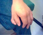 A polidactilia  uma anomalia causada pela manifestao de um alelo autossmico dominante com penetrncia incompleta, consistindo na alterao quantitativa anormal dos dedos da mo (quirodctilos) ou dos dedos do p (pododctilos). H uma variao muito grande na expresso dessa caracterstica, desde a presena de um dedo extra, completamente desenvolvido, at a de uma simples profuso carnosa. </br></br> Palavras-chave: polidactilia, mutao, gentica, mo, p. 